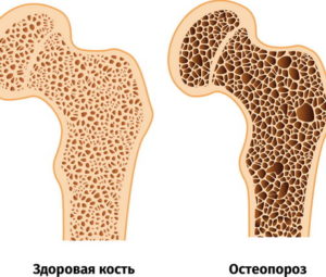 osteoporoz